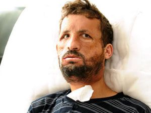 Yüz nakli sonrası inanılmaz degişim