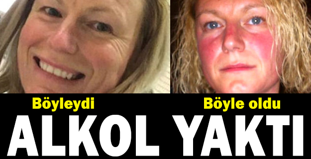 Alkol içen kadının vücudu yandı!