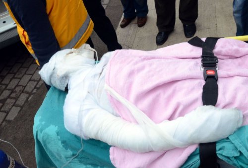 Yangından Kurtulan Anne Ankara’ya Sevk Edildi